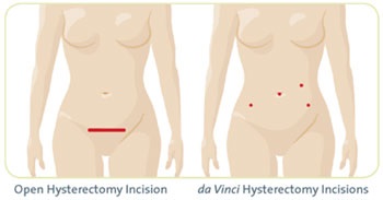 Gynecologic Robotic Surgery