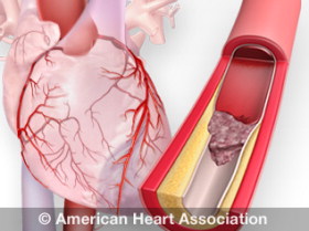 American Heart Association graphic